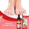 Ingrown Toenail & Cuticle Support Oil – Helps Maintain Nail