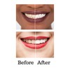 Deluxe Teeth Whitening Kit with Multiple Percentages of Carbamide Peroxide