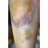 Arnica Bruise Cream Arnica Oil for Bruising Arnica Massage Oil