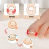 Ingrown Toenails Set, Nail Clip, Toenail Set for Correction of