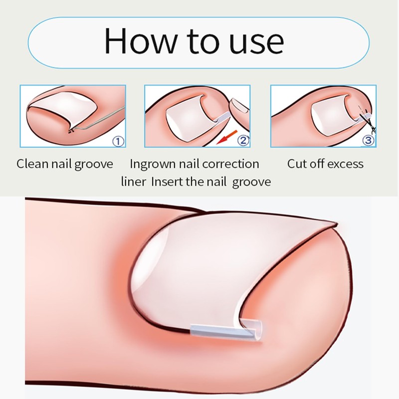 CHEMAILON Professional Ingrown Toenail Correction Kit - Stainless Steel Ingrown