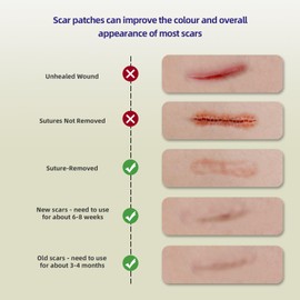 Silicone Scar Sheet, Silicone Scar Tape for Surgery (1.6” x120” Roll-300CM), Silicone Scar Strips, Keloid Treatment, C-Sections, Surgical Scars, C-Section Scars