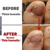 IDOU Toenail Files for Thick Nails, Stainless Steel, 4 Sides,