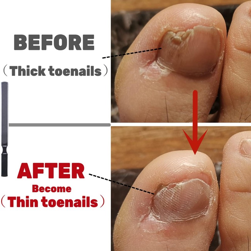 IDOU Toenail Files for Thick Nails, Stainless Steel, 4 Sides,