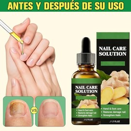 SINYI 2pcs Ginger Nail，Tratamiento de Uñas con Jengibre，Treatment Nail Support Nail Care，Promueve el crecimiento de las uñas y las nutre; adecuado par