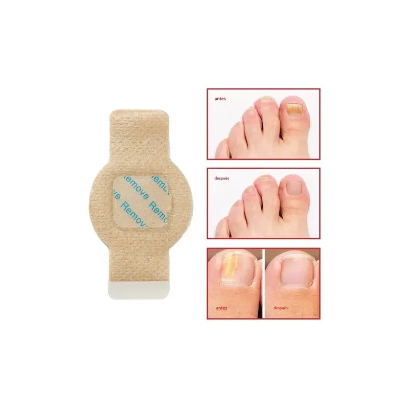 ~ Parches Para Uñas Fc Fungal, 63 Unidades/caja De Parche