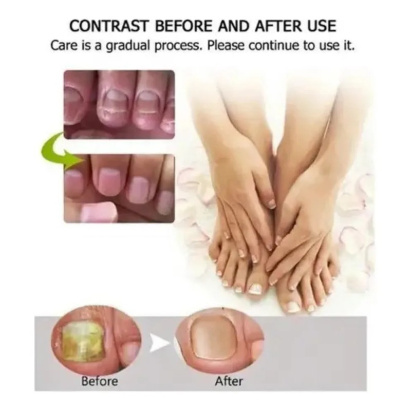 1pzs Crema Natural Hongos Uñas Pies Efero Gel Reparador 20ml