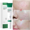 블랙헤드 모공수축 기미개선 아크네 크림 살리실산 아젤라익산 Blackhead Pore Tightening