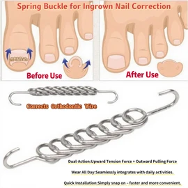 Zanchara Ingrown Toenail Corrector Tool - Nail Lifter & 3 Sizes Wire Fixer for Curved Nail Repair - Ingrown Toenail Removal Kit (0.63, 0.71, 0.79in)