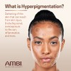 Ambi Even Clear Advanced Fade Cream, Hydroquinone-free, Hyperpigmentation Treatment, Stubborn