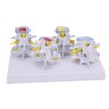 4-stage Medicals Human Lumbar Vertebrae Combination of Normal and Pathological