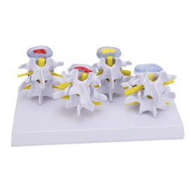 4-stage Medicals Human Lumbar Vertebrae Combination of Normal and Pathological Models