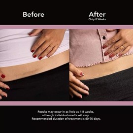 Scaraway C-sections Parches Cesárea Abdominoplastia
