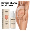 Crema Para Acné En Glúteos 100ml Elimina Granos Y Espinillas