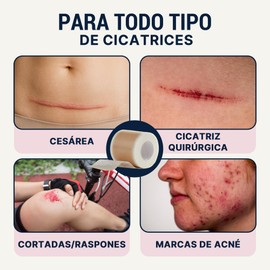 Over Lu DermaSilk™ | Cinta de Silicona para Cicatrices – Parches de Silicona Reutilizables para Cicatrices Quirúrgicas, Cesárea, Acné y Estrías – Grado Médico - 1.5 metros