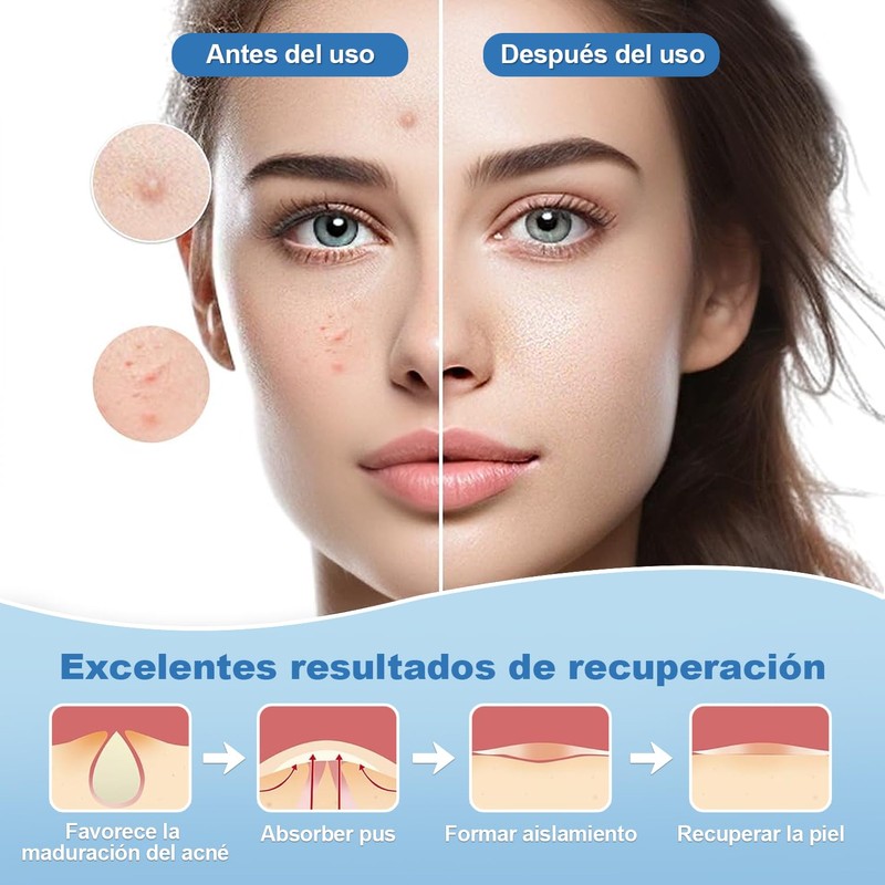 Parches para Acne,Pimple Patch,200 Almohadillas Hidrocoloides para Espinillas, Parches para