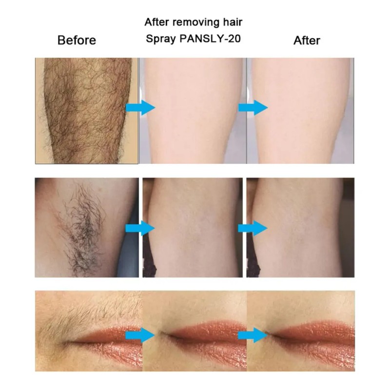 50ml Inhibidor Del Crecimiento Del Cabello Barba Permanente
