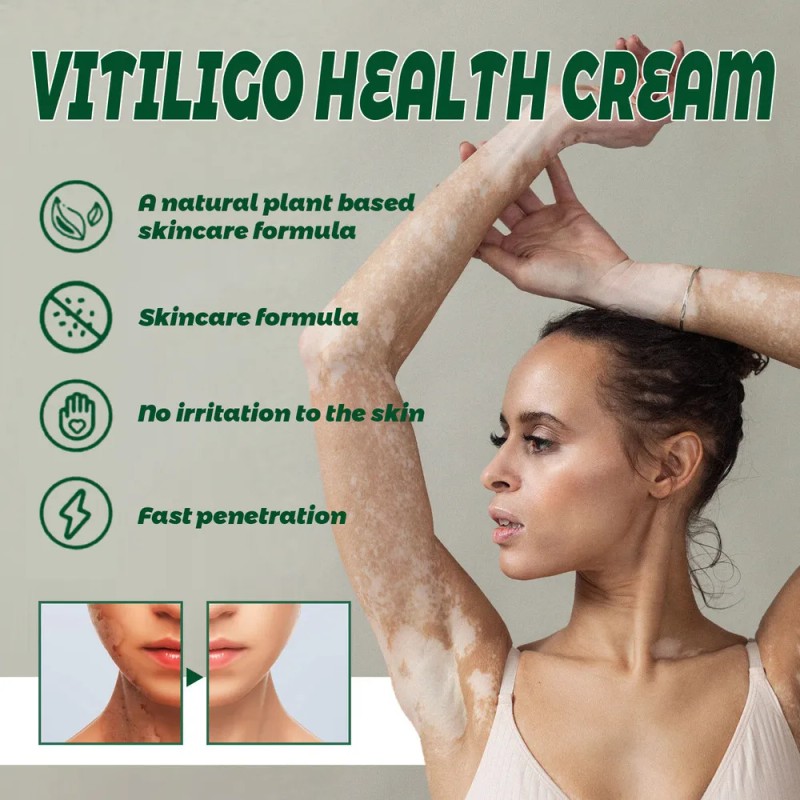 Vitíligo Aceite White Vitíligo Para 4×crema T