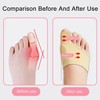 iCovalescent Hallux Valgus Socks, Large Toe & Foot Toe Relief