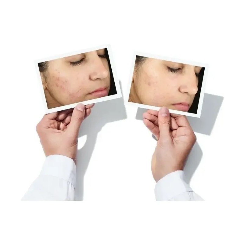 Murad Invisiscar Crema Blemish Ácido Salicílico Vitamina C Marcas Acné