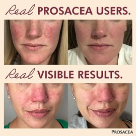 Prosacea - Heals Rosacea Symptoms of Redness, Pimples and Irritation - 0.75 oz (Pack of 2)
