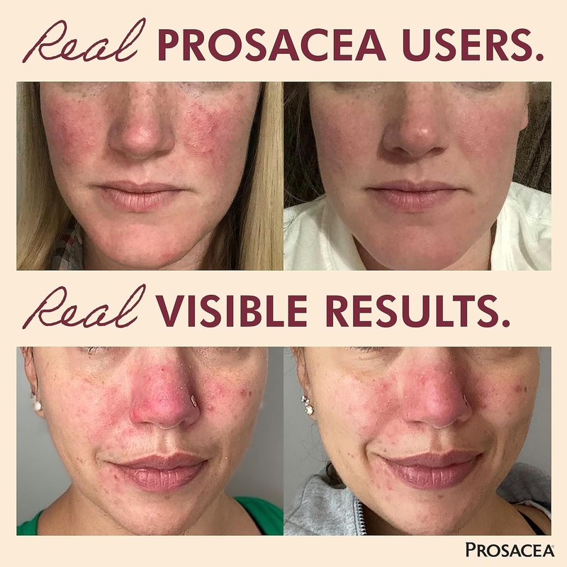 Prosacea - Heals Rosacea Symptoms of Redness, Pimples and Irritation