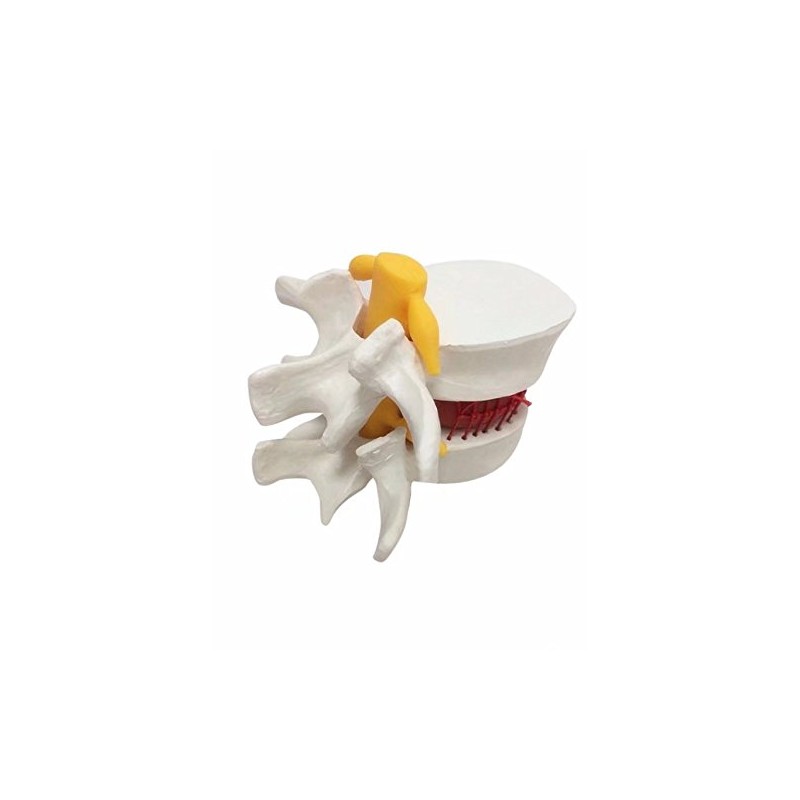 BoNew 1:1.5 Anatomical Human Lumbar Vertebrae Degenerative Lumbar Human Spine