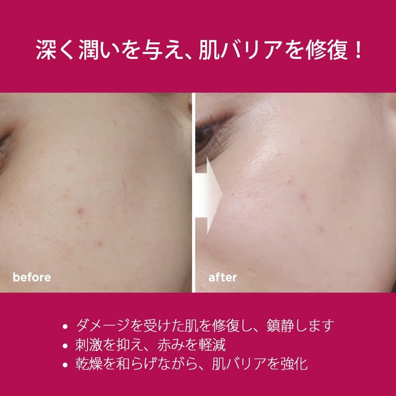 Nightingale Sepashica Cream, Moisturizing Cream with 65.2% CEPACICA Extract &