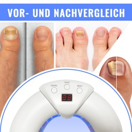 Funthy Nail Laser Fungus Device for Multiple Toenails & Fingernails with 405 nm Infrared Light + 365nm Blue Light,Nail Repair Solution for Damaged and Discolored Nails, Suitable for Home Use (White)