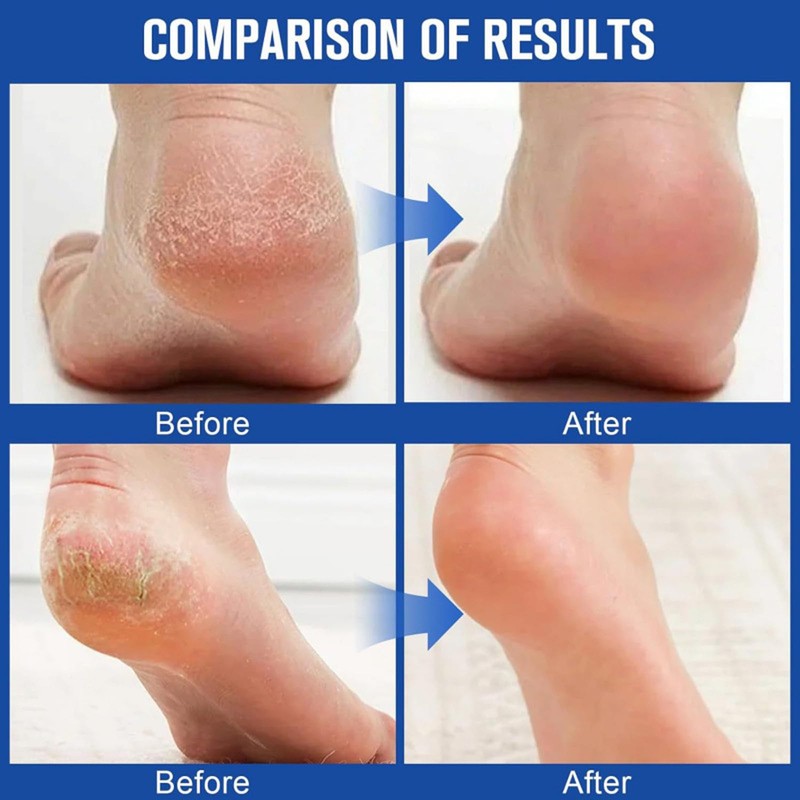Urea Cream 60 Percent for Feet with 2% Salicylic Acid,