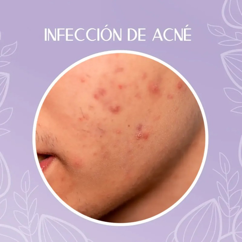 Crema Despigmentante Para Manchas, Melasma, Acné Y Paño