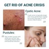 Cerave Acne Control Cleanser Facial Cleanser For Pimple Remover 237ML