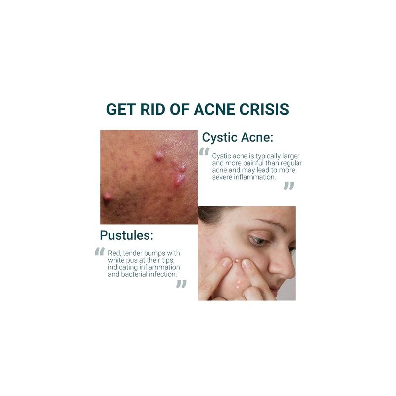 Cerave Acne Control Cleanser Facial Cleanser For Pimple Remover 237ML