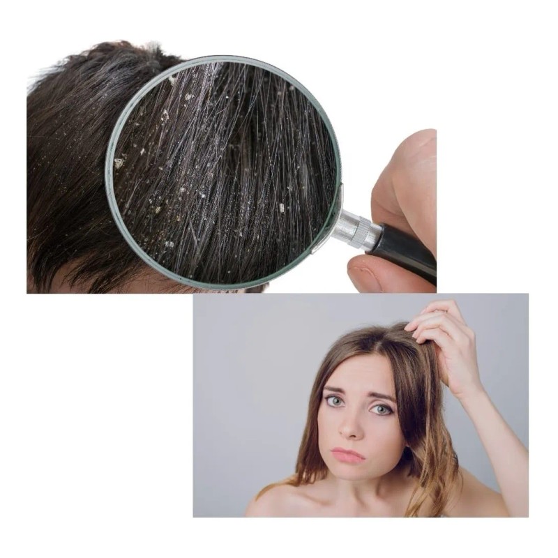 Tratamiento Anticaspa Profesional Shampoo Y Ampolletas