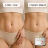 Roserenew Crema Antiestrías, Cicatrizante Y Antiacne