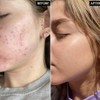 The Inkey List Beta Hydroxy Acid Serum