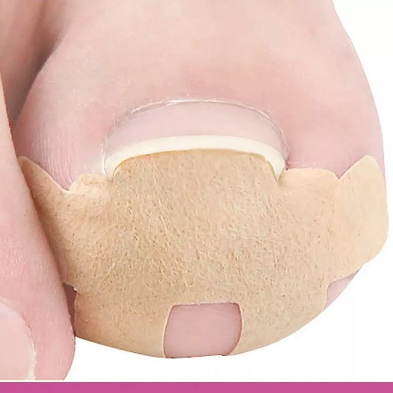 Universo en Linea Pegatinas Correctoras De Uñas Enterradas 4 Plantillas