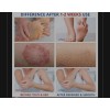 Charmpoo Treatment for Jock Itch,Ringworm, Psoriasis,Ecze