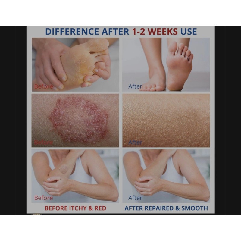 Charmpoo Treatment for Jock Itch,Ringworm, Psoriasis,Ecze