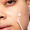 Drying Lotion - On-The-Spot Solution for Blemishes Skincare Acne Spot