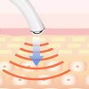 눈꺼풀처짐 눈꼬리올리기 눈꺼풀처짐리프팅 짝눈 교정 [필수/화이트] Eyelid Droop Lifting, Eyelash