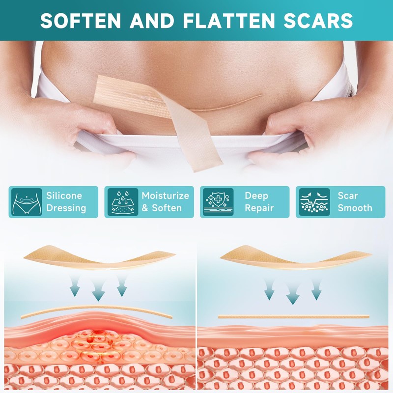 Silicone Scar Sheets, Silicone Scar Tape(1.8” x 157” Roll-4M), Scar