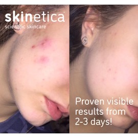 Skinetica Quintessence Face Toner for Acne, Spots and Blemishes 100ml | No Harsh Chemical, Paraben-Free & Vegan Friendly Toner for Face | Refreshing & Non-Irritating Skin Toner for Sensitive Skin