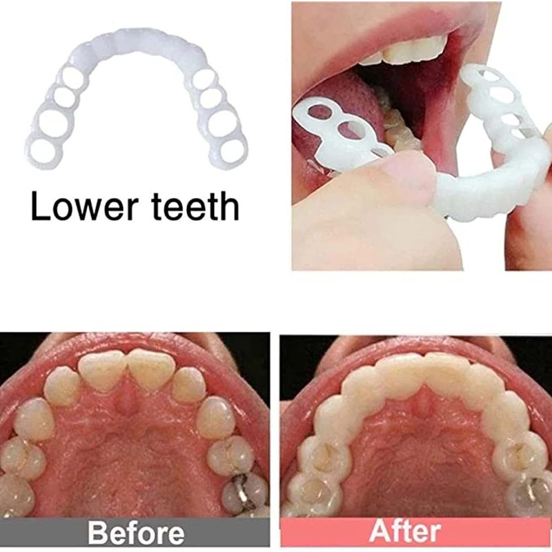 Adjustable Smile Supports - 2 Pairs (Top & Bottom) |