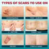 Medical Grade Silicone Scar Tape - 1.6”x120” - Visible Difference