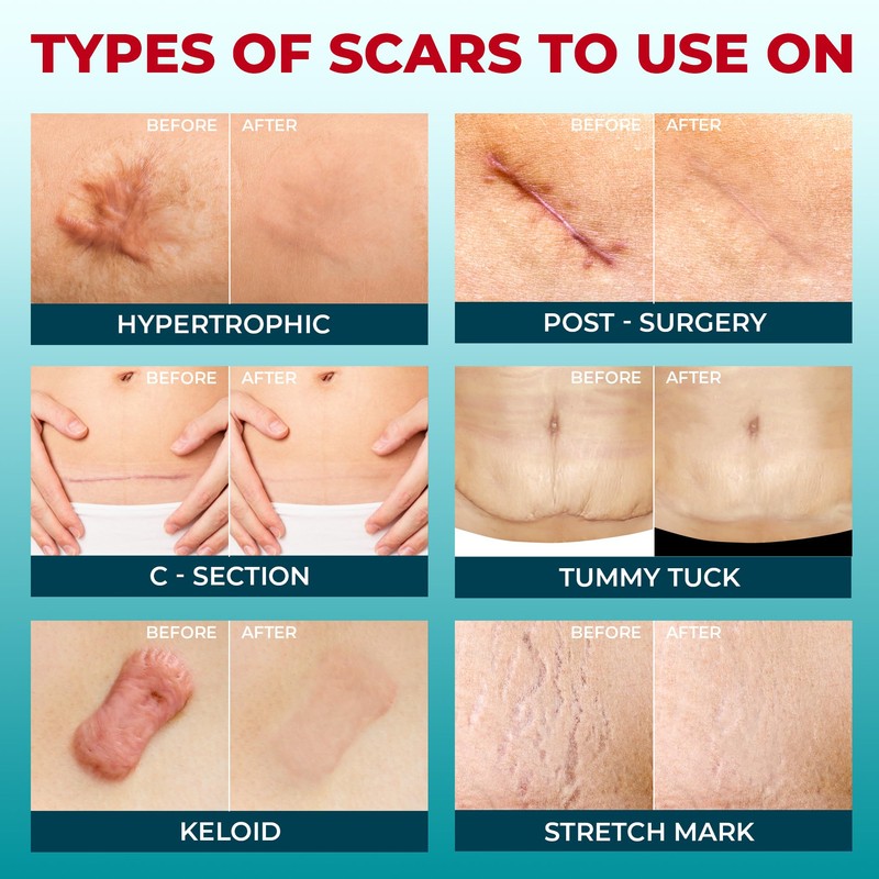 Medical Grade Silicone Scar Tape - 1.6”x120” - Visible Difference