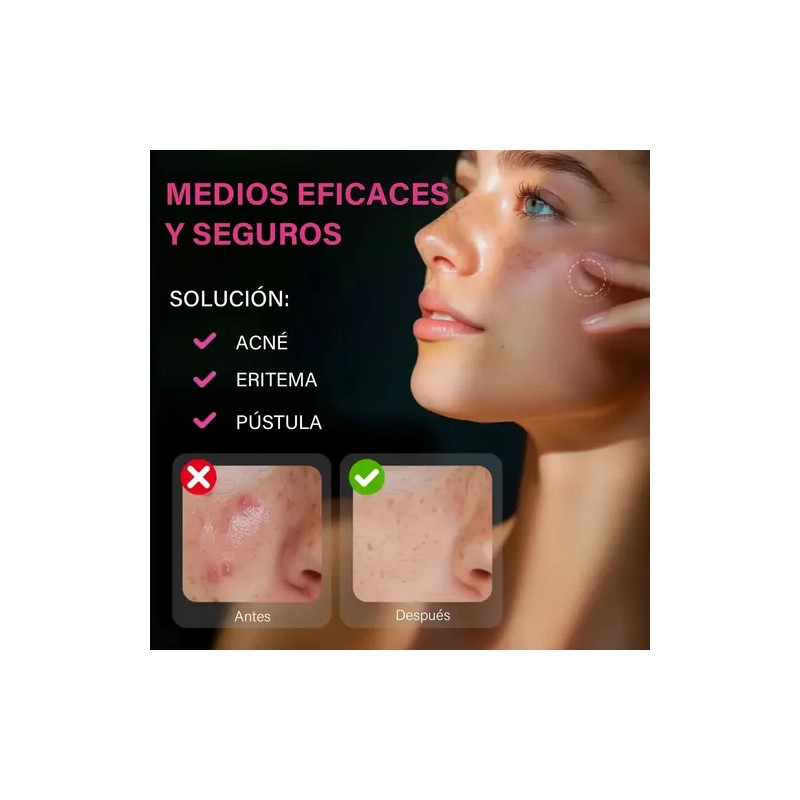 Parches Acne Con Micropuntos Granos,barros,día Y Noche Acneica Día/noche