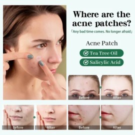 Abcify Parches Hidrocoloides Anti Acné Invisibles 12 Piezas                                                                                           