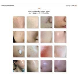 Philotica Exiol Hot flush Acne scars Red marks Pigmentation Facial flushing Dermatology Regenerative Ointment Cream Exiol Serum 80ml / 필로티카 엑시올 얼굴 열감 여드름흉터 붉은자국 색소침착 안면홍조 피부과 재생 연고 크림 엑시올 세럼80ml