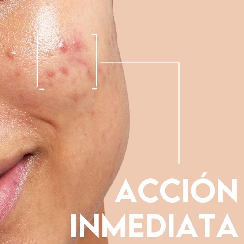 ACNIDUL | Roll-on immediate action with glycolic acid and calendula